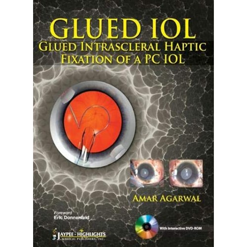 GLUED IOL GLUED INTRASCLERAL HAPTIC FIXATION ...