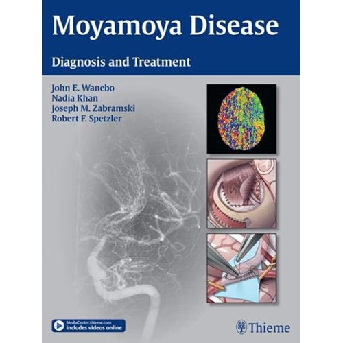 Moyamoya Disease - Diagnosis and Treatment 1s...