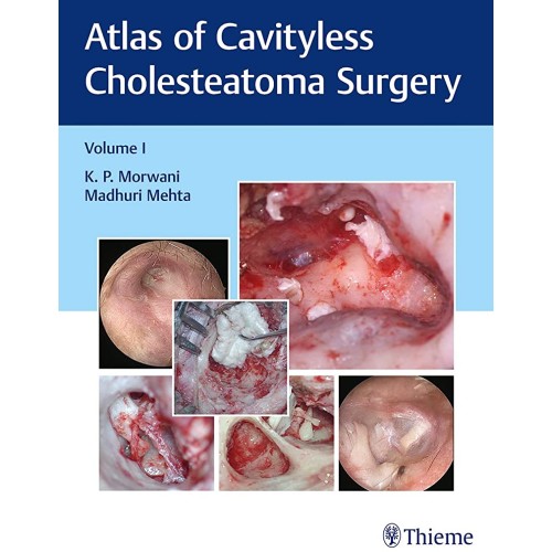 Atlas of Cavityless Cholesteatoma Surgery (Vo...